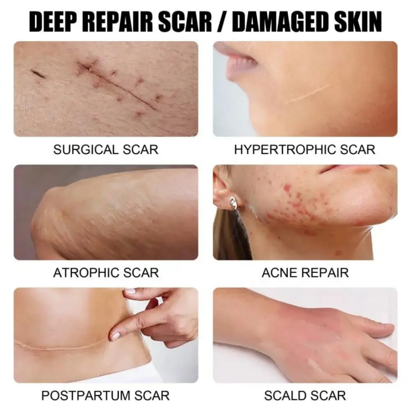 Gel cicatrice, Scar gel, gel cicatrisant